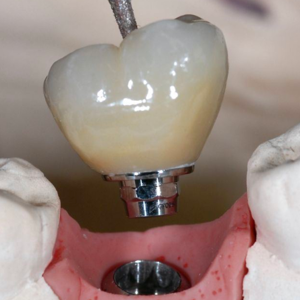 The Implant – Implant Club